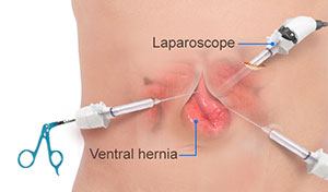 Hernia Repair (Laparoscopic Procedure for Abdominal Hernia)